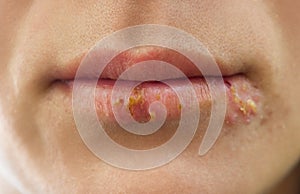 Lips affected by herpes