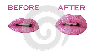 Lips before and after augmentation on a white background augmentation