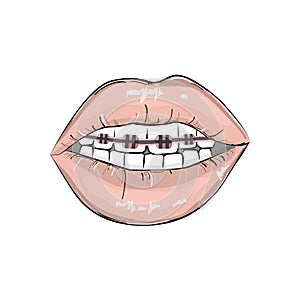 lips braces illustration. Erotic playful hot clipart. Modern smile fashion illustration. Pop art open mouth with teeth and de