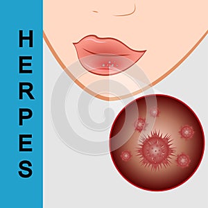 Lips closeup with cold herpes, sore on the lip