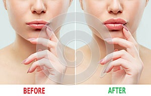 Before and after lips filler injections. Beauty plastic. Beautiful perfect lips with natural makeup.