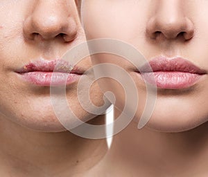 Lips with herpes before and after treatment.