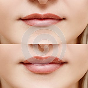 Lips of woman before and after augmentation.