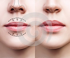 Lips of young woman before and after augmentation