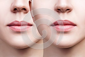 Lips of young woman before and after augmentation