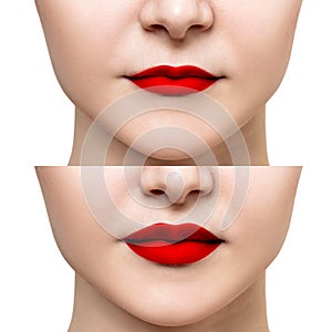 Lips of young woman before and after augmentation.