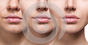 Lips of young woman before and after augmentation