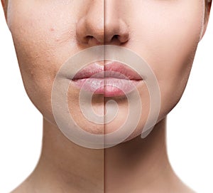 Lips of young woman before and after augmentation