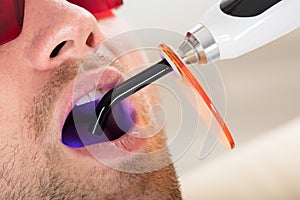 Lit Dental Curing UV Light In Man`s Mouth