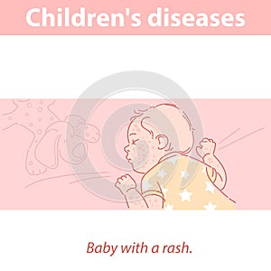 Little baby with rash on face and body.