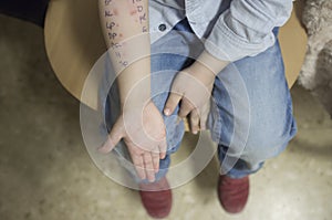 Little boy arm full of weals just after doing allergy skin prick test