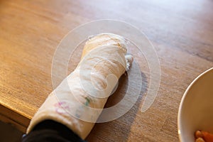 Little boy with a broken wrist at the table. Boy with a plaster on his arm