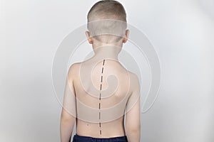 A little boy at the doctor`s appointment with back pain. Treatment of spinal deformity and stoop. Osteoporosis, kyphosis, lordosi