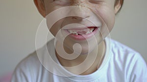 Little boy shows that some of his milk teeth had fallen out. Concept of tooth change in children