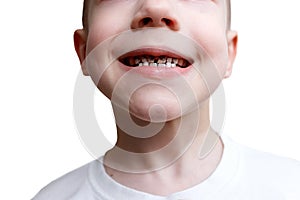 Little boy in t-shirt smiles and shows his teeth destroyed by caries. Health care, dental hygiene and childhood concept