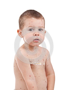 Little boy whit smallpox photo