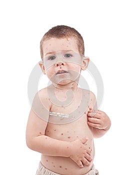 Little boy whit smallpox photo