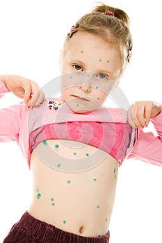 Little child with Varicella zoster