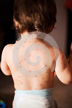 Little girl with chicken pox rash photo