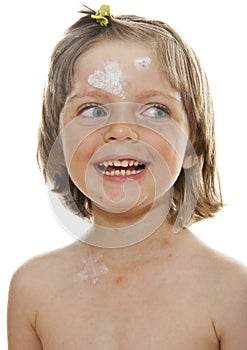 Little girl with chickenpox