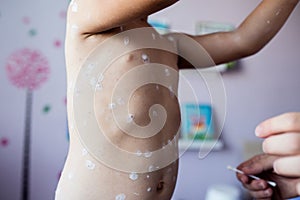 Little girl with chickenpox, antiseptic cream applied to the rash