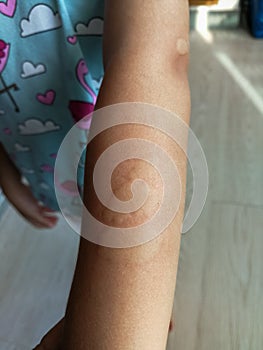 Little girl has allergies with mosquitoes bite and itching her skin. Mosquito blood breeding on kids.Repellent, Dengue virus,