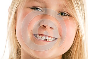 Little girl with missing teeth