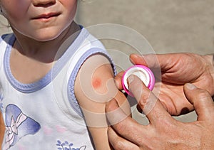 Little girl with mosquito bite on arm