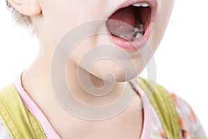 Little girl opens her mouth and shows sick tooth