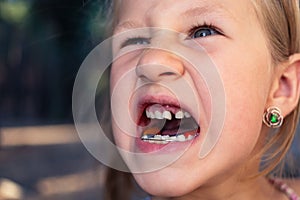 Little girl with orthodontics appliance and crooked teeth. Wobbly tooth