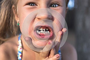 Little girl with orthodontics appliance and crooked teeth. Wobbly tooth