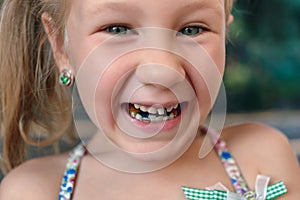 Little girl with orthodontics appliance and wobbly tooth