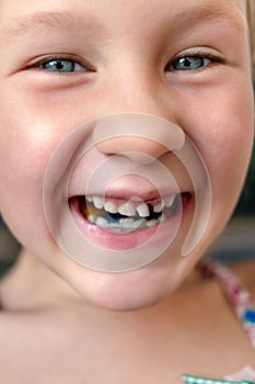 Little girl with orthodontics appliance and wobbly tooth