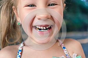 Little girl with orthodontics appliance and wobbly tooth