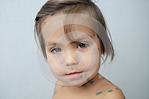 Little girl portrait with chickenpox. Sick little girl with varicells making eruption on skin. Long home quarantine