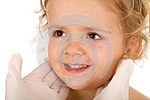 Little girl with small pox at the doctors photo