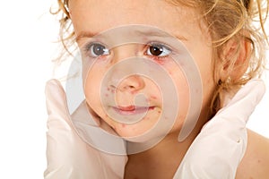 Little girl with small pox at the physician photo