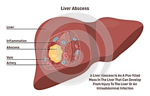 Liver abscess. Human internal organ tissue inflammation and pus formation.