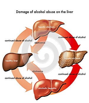 Liver and alcohol