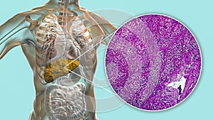 Liver with biliary cirrhosis