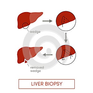 Liver biopsy