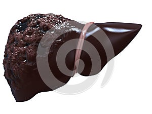 Liver cancer