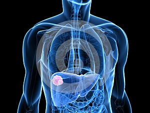 Liver cancer