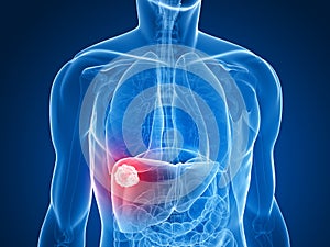 Liver cancer