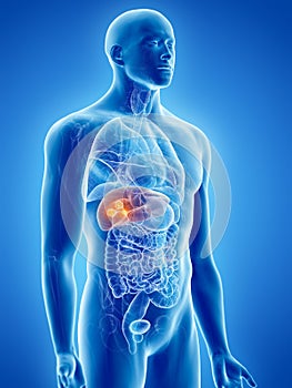 Liver cancer