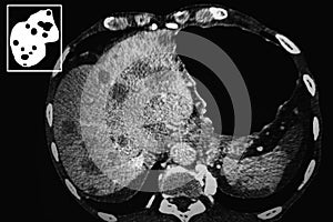 Liver. Cancer . Computer Tomography reconstruction. photo