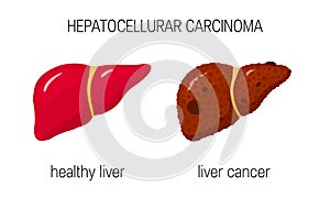 Liver cancer concept