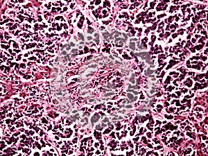 Liver cancer of a human