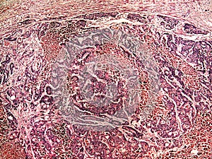 Liver cancer of a human photo