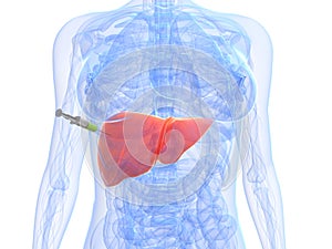 Hígado cáncer inyección biopsia 